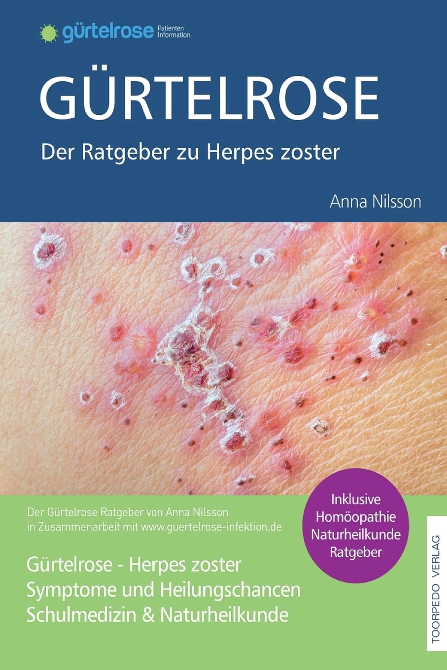 Grtelrose - Der groe Ratgeber zu Herpes zoster: Schulmedizin +  Naturheilkunde : Nilsson, Fr Anna: Amazon.de: Bcher