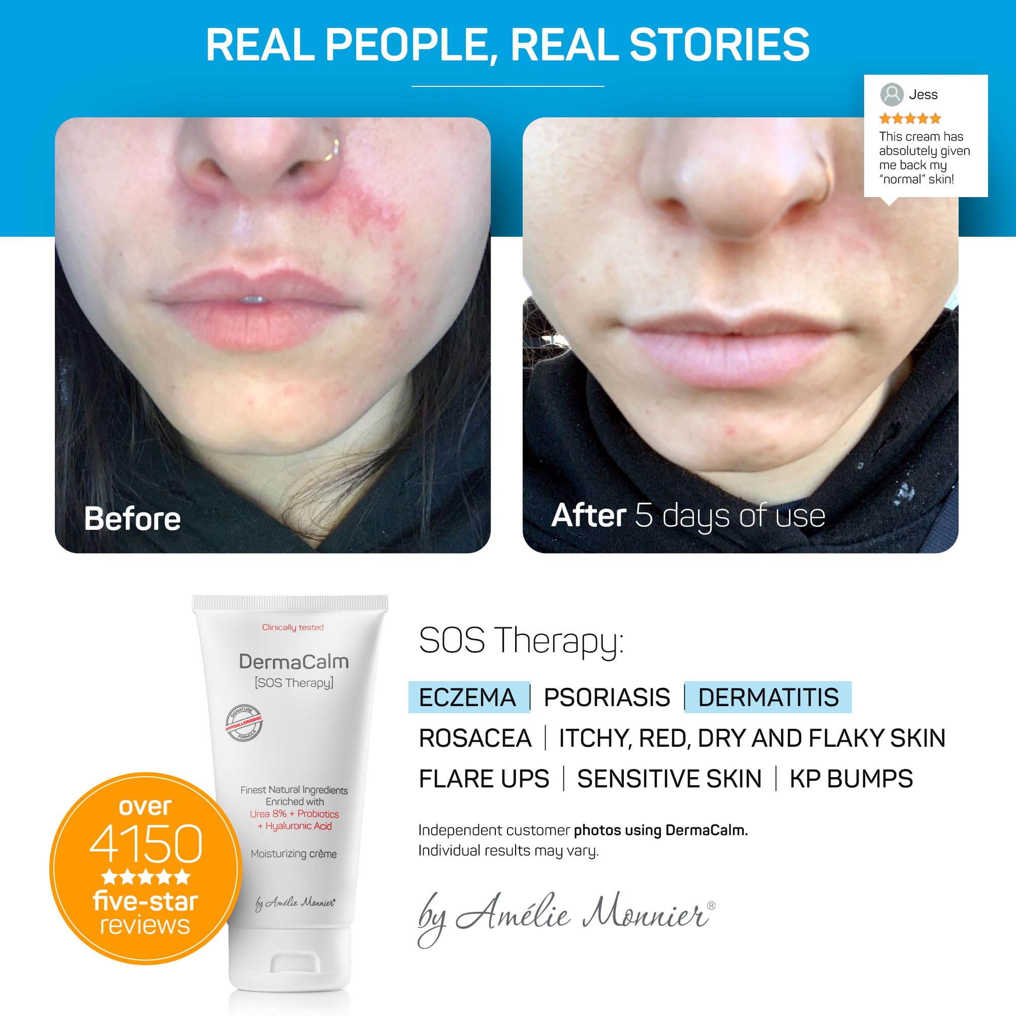 Clinically Tested DermaCalm SOS Therapy - Eczema Psoriasis Dermatitis Prone, Dry Skin - Urea 8%, Probiotics w/Best Natural Ingredients - Itchy, Severely Dry, Scaly Skin. Adults & Kids, Eczema Cream — Amazon image 4