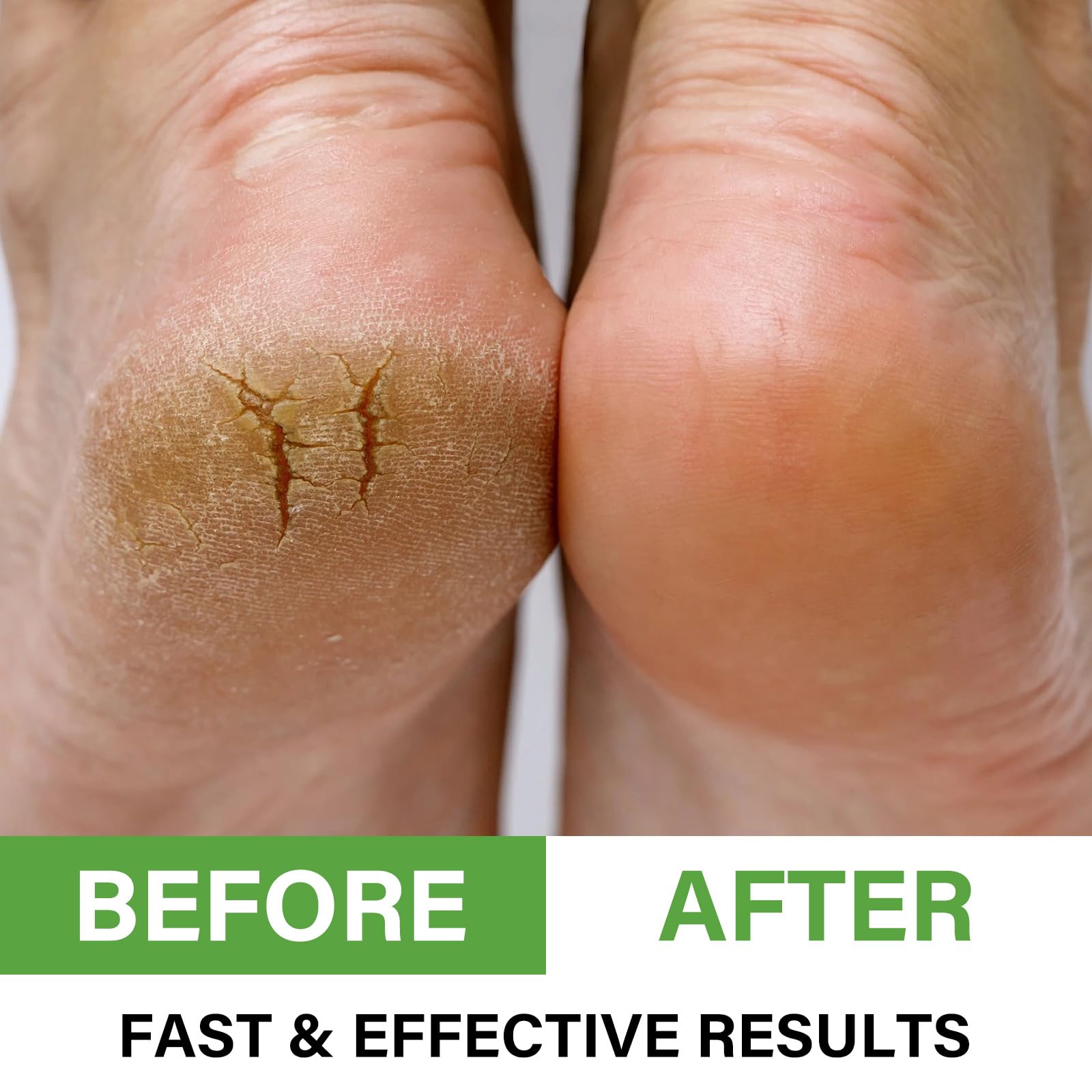 AOPEIBOTO Urea Cream for Feet Foot Cream for Very Dry Feet Cracked Heels, Hard and Dry Skin, Foot Moisturiser, 5.29oz/150g - Image 3