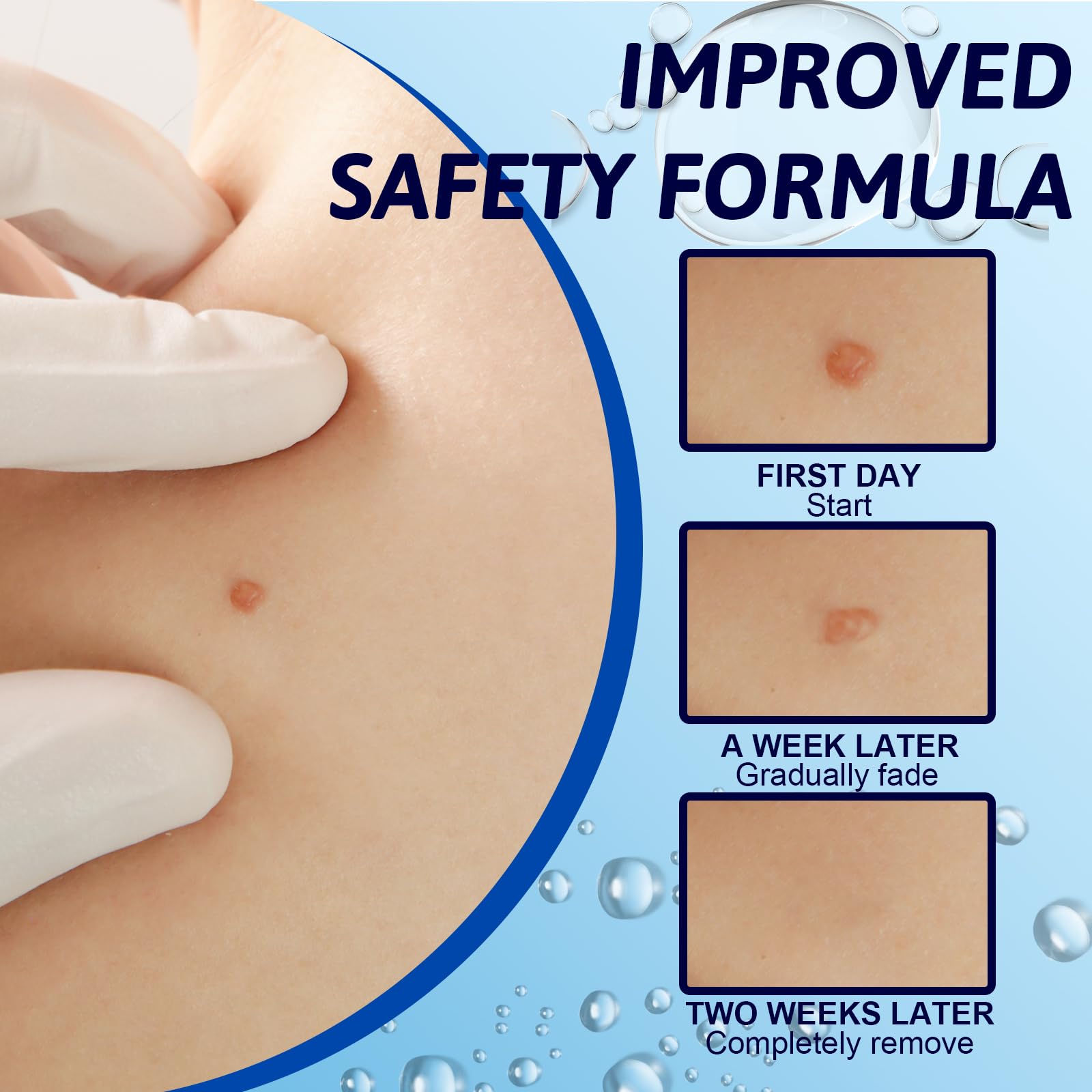 30ml Líquido para Verrugas Corporales y Faciales, Cuidado Exfoliante de la Piel, Cuidado Cutáneo para Manos y Piel