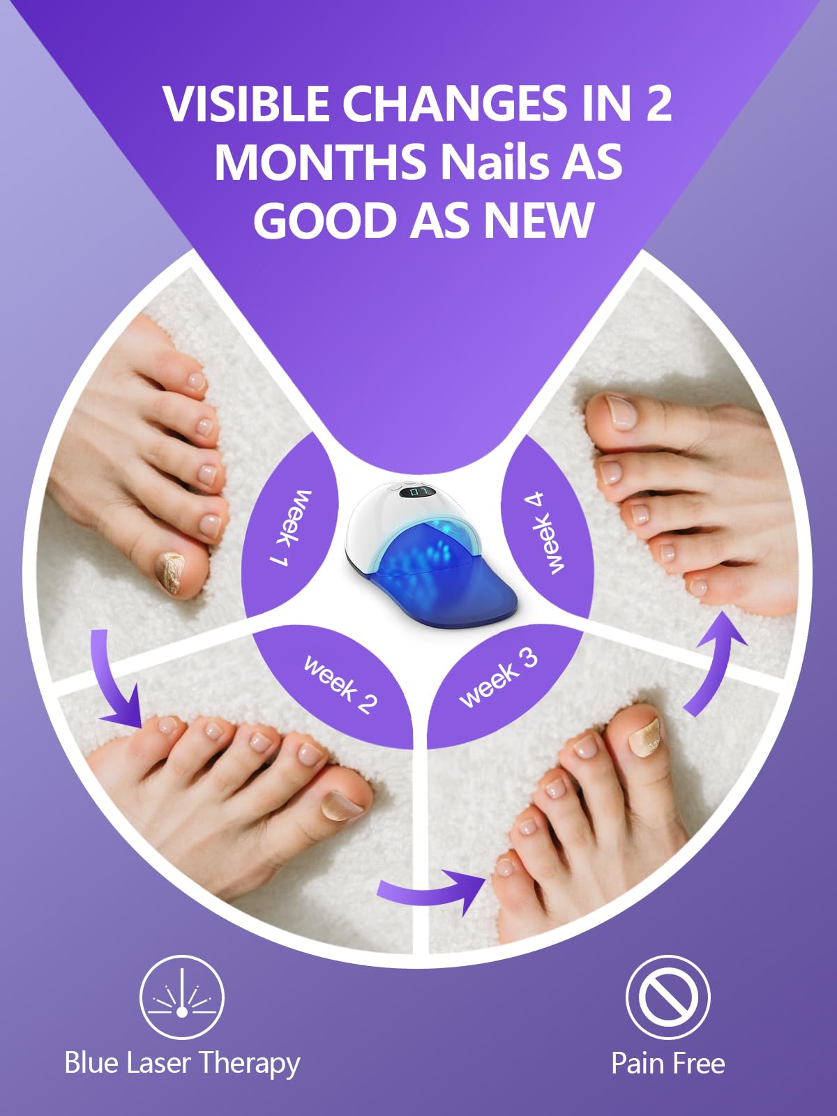 iKeener Dispositivo de terapia de actualización láser para dedos de manos y pies, sesiones ajustables 5/7/10 minutos, limpieza láser de uñas y onicomicosis, removedor de hongos en las uñas, con luz