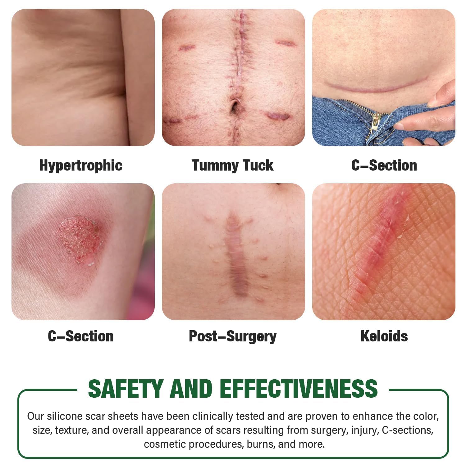 Silicone Scar Sheets, Silicone Scar Tape, Silicone Sheets For Scars, Scar Tape For Surgical Scars, Scar Removal For Surgical (3M)