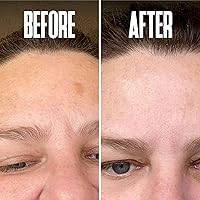 Vista 6 de Eliminador corrector de puntos oscuros de hidroquinona 2% para el tratamiento facial y melasma, contiene vitamina C, ácido salicílico, ácido kójico