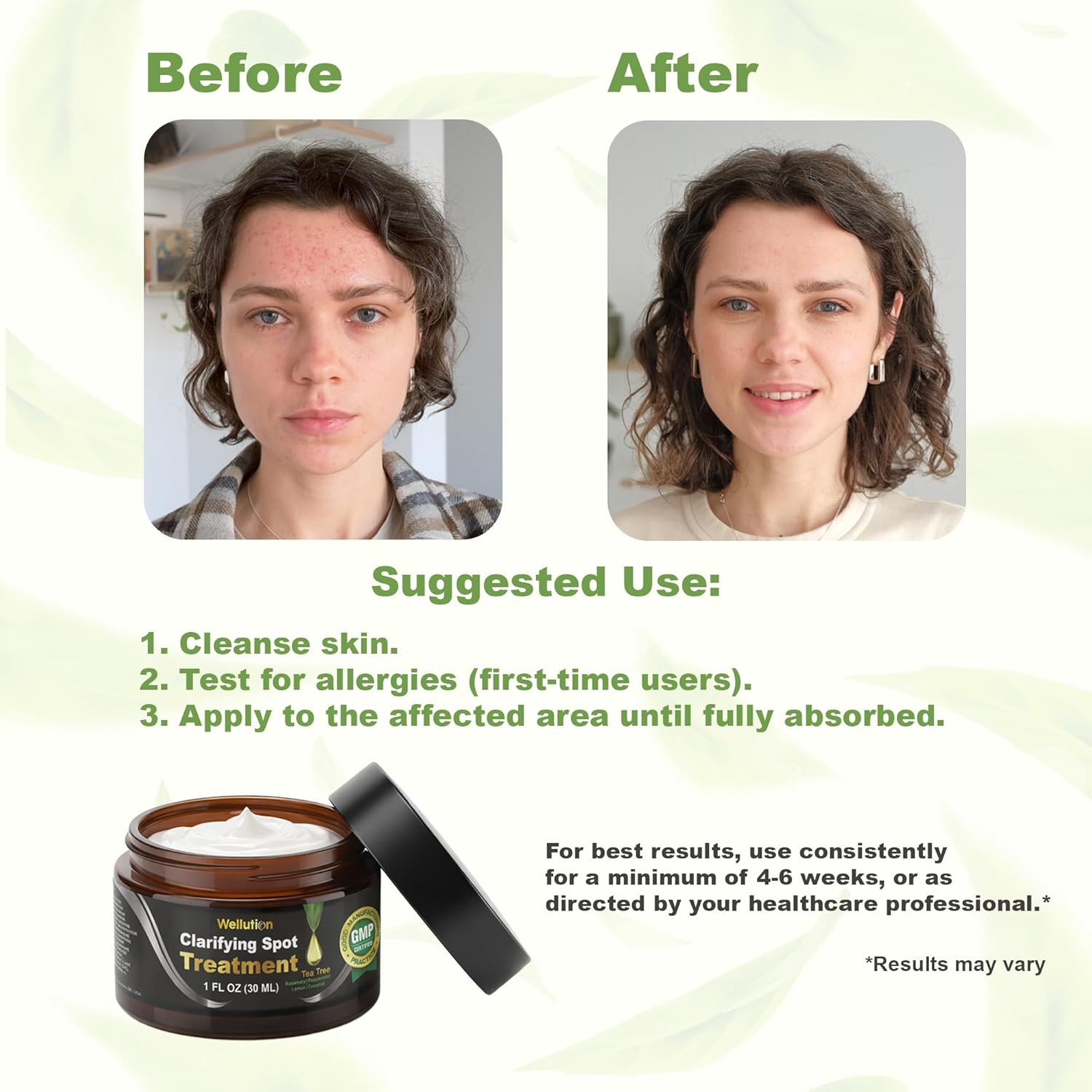 Cystic Acne Spot Treatment – Tea Tree Acne Cream – Fast-Acting Acne Spot Corrector for Face, Pimples & Blemishes – Non-Greasy, Gentle Formula – 1oz – by WELLUTION - Image 6