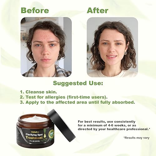 Miniatura 6 de Tratamiento de manchas de acné quístico – Crema para el acné de árbol de té – Corrector de manchas de acné de acción rápida para cara, granos e