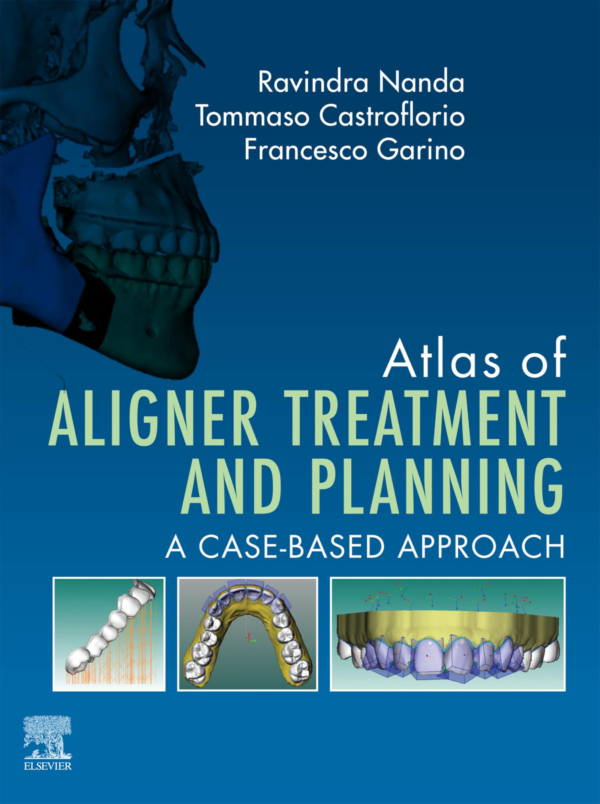 Atlas of Aligner Treatment and Planning - E-BOOK (English Edition)