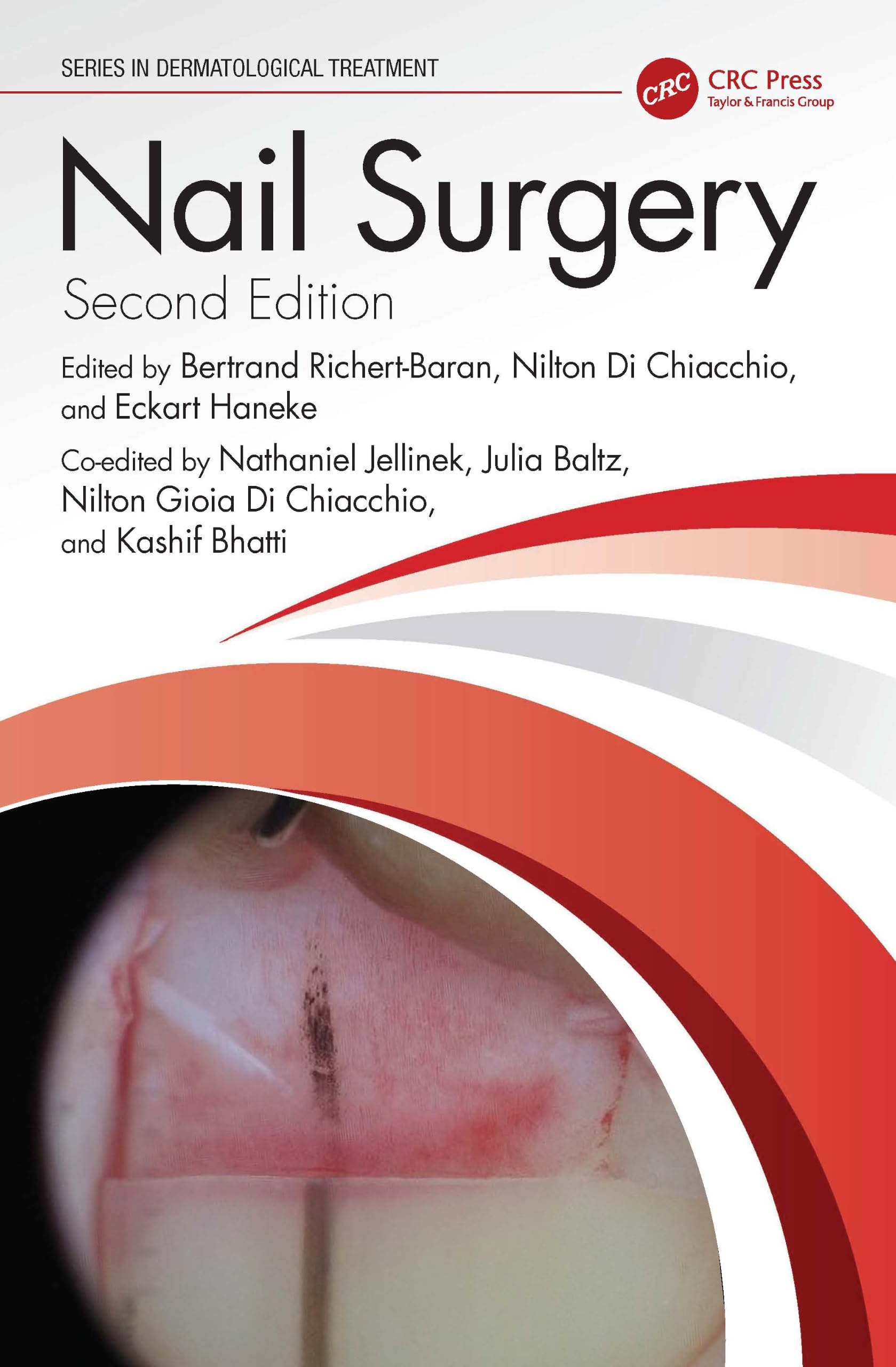 Nail Surgery