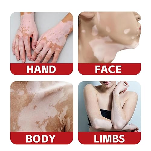 Miniatura 4 de Spray de tratamiento de vitíligo, tratamiento de vitíligo natural para la piel, mejora la pigmentación de la piel, crema de vitíligo adecuada para
