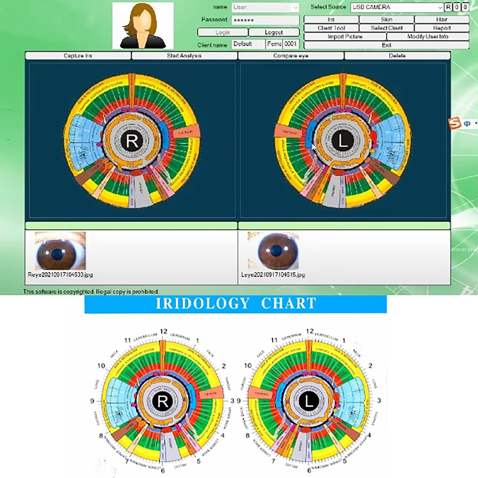 Iris-analysekamera, Multifunktions-iris-analysegerät Mit Software, Hd-auflösung Mit 12 Megapixeln, Für Kosmetikstudios, Spas Und Zuhause