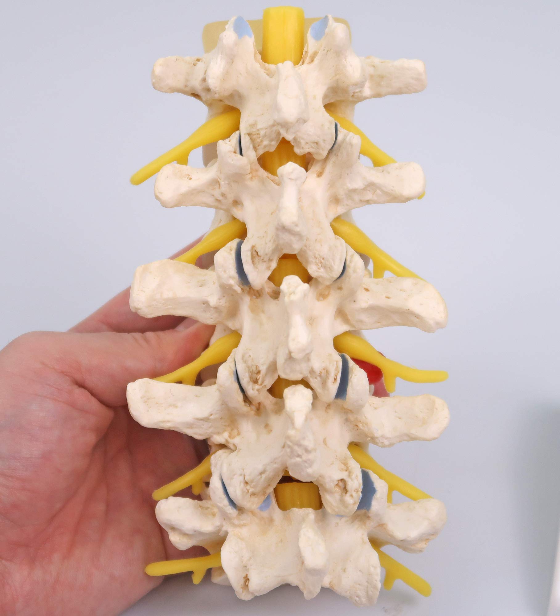3B Scientific A795 Stadi dell'Ernia del Disco Intervertebrale e Degenerazione della Vertebra + software gratuito di anatomia - 3B Smart Anatomy