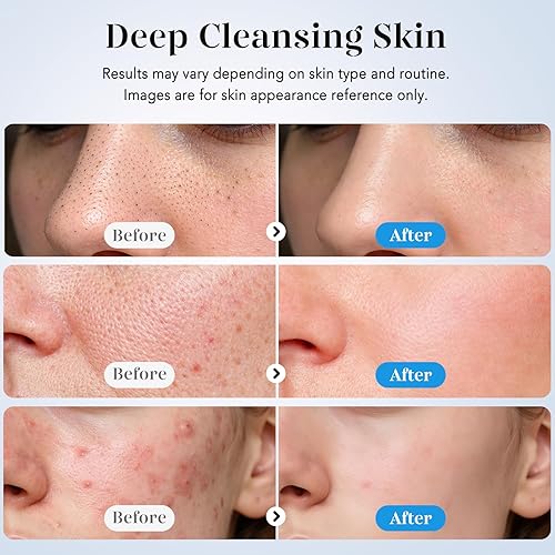 GUGUG Skin Scrubber Face Spatula Skin Spatula Pore — alternate color or size variant on Amazon