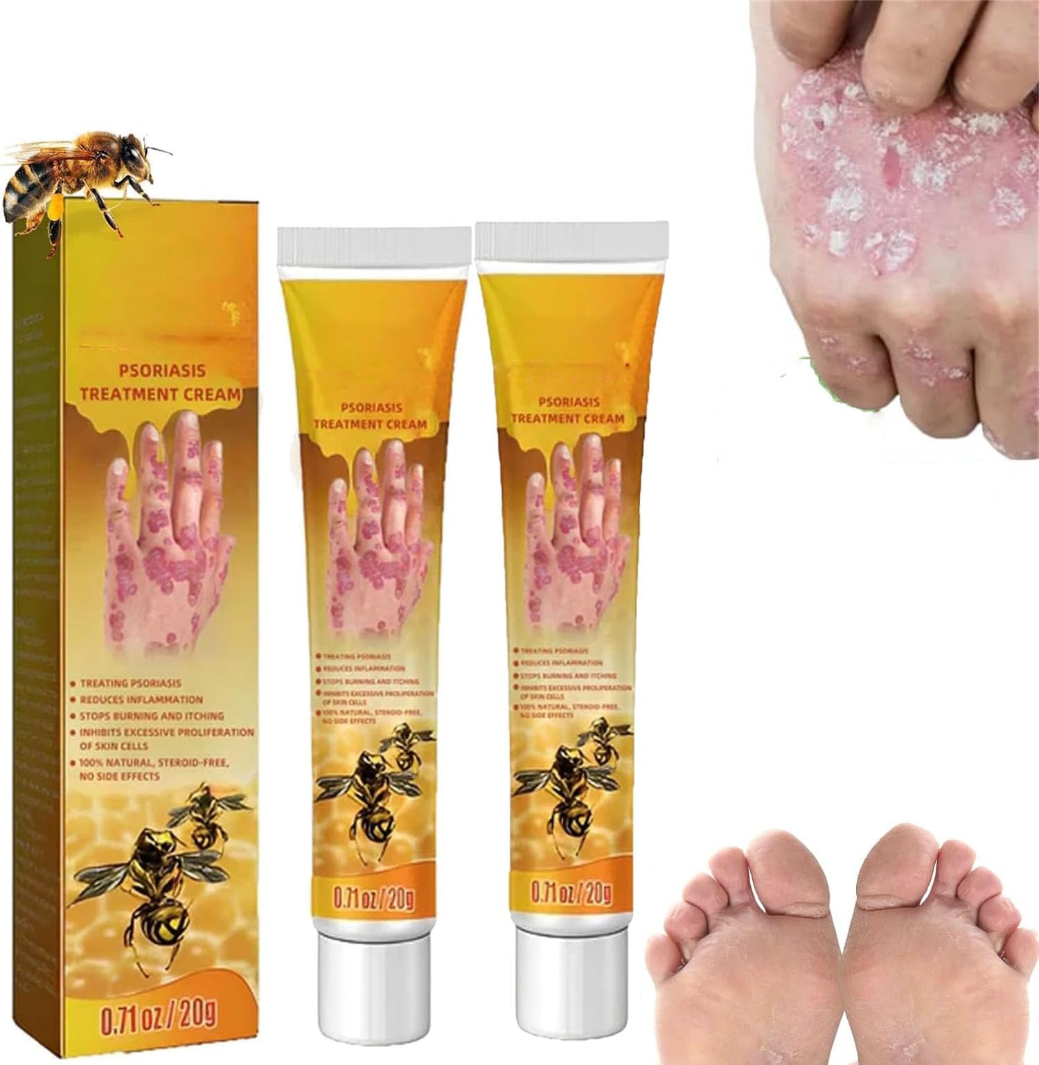 Bee V-enom Psoriasis Cream,Bee V-enom Professional Psoriasis Treatment Cream,Soothing and Moisturizing Psoriasis Cream,Lightweight & Fast-Absorbing,Relieve Skin Itchiness (2 Pcs)