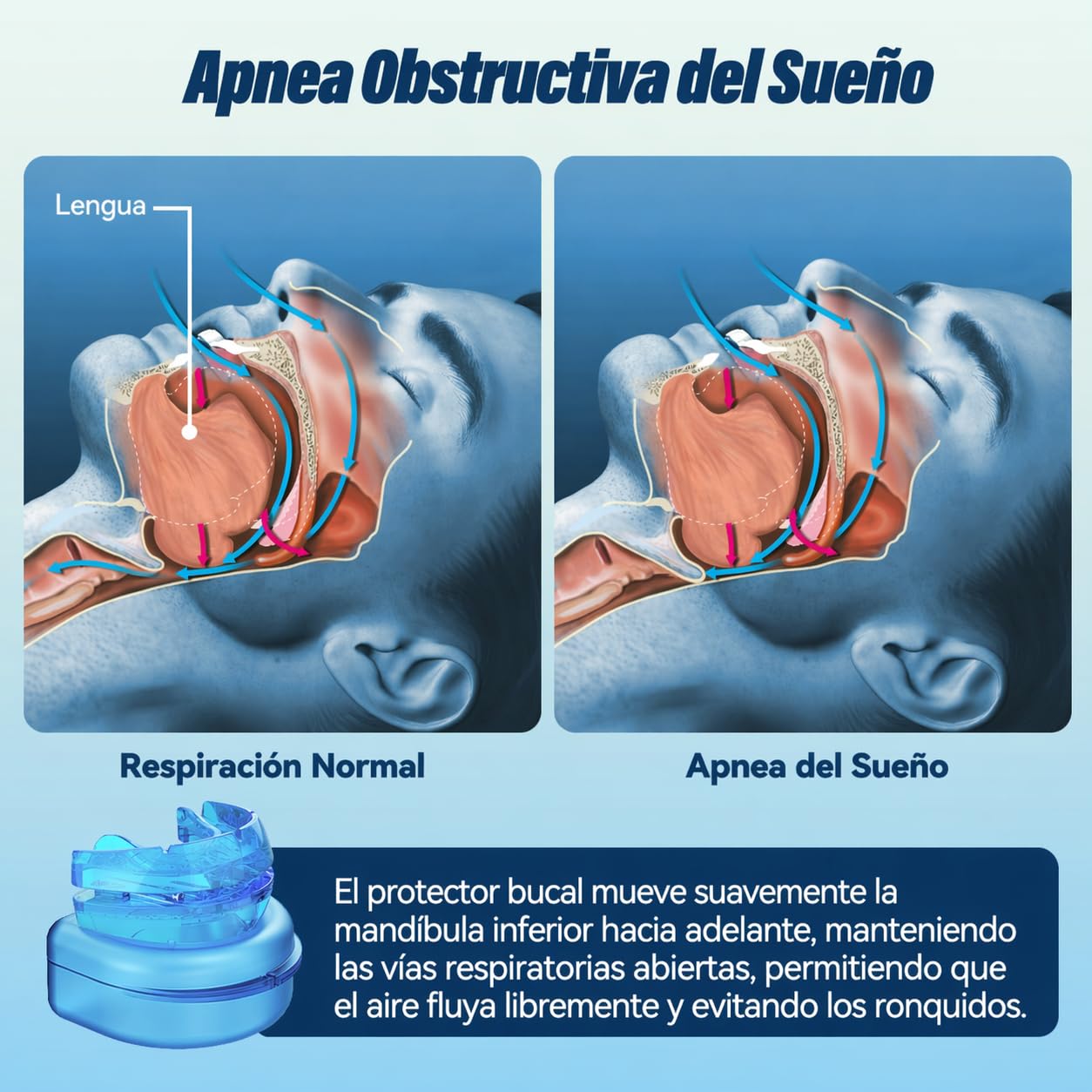 Dispositivo Antironquidos Ajustable – Férula Anti Ronquidos para Dormir, Diseño Cómodo para Uso Nocturno, Mejora del Descanso y Respiración, Bleu
