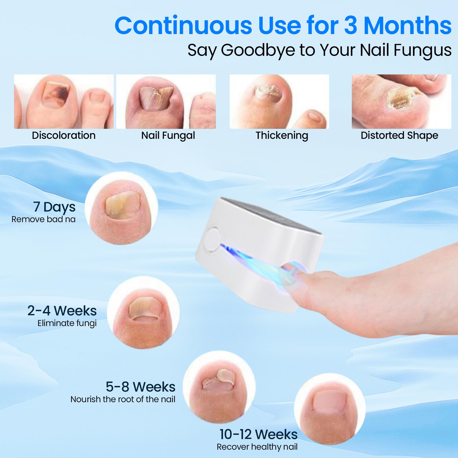 Dispositivo láser para hongos de las uñas de 7 minutos con indicador de tiempo, dispositivo de tratamiento de hongos de las uñas, tratamiento anti-hongos para uñas rápido y efectivo para varios dedos