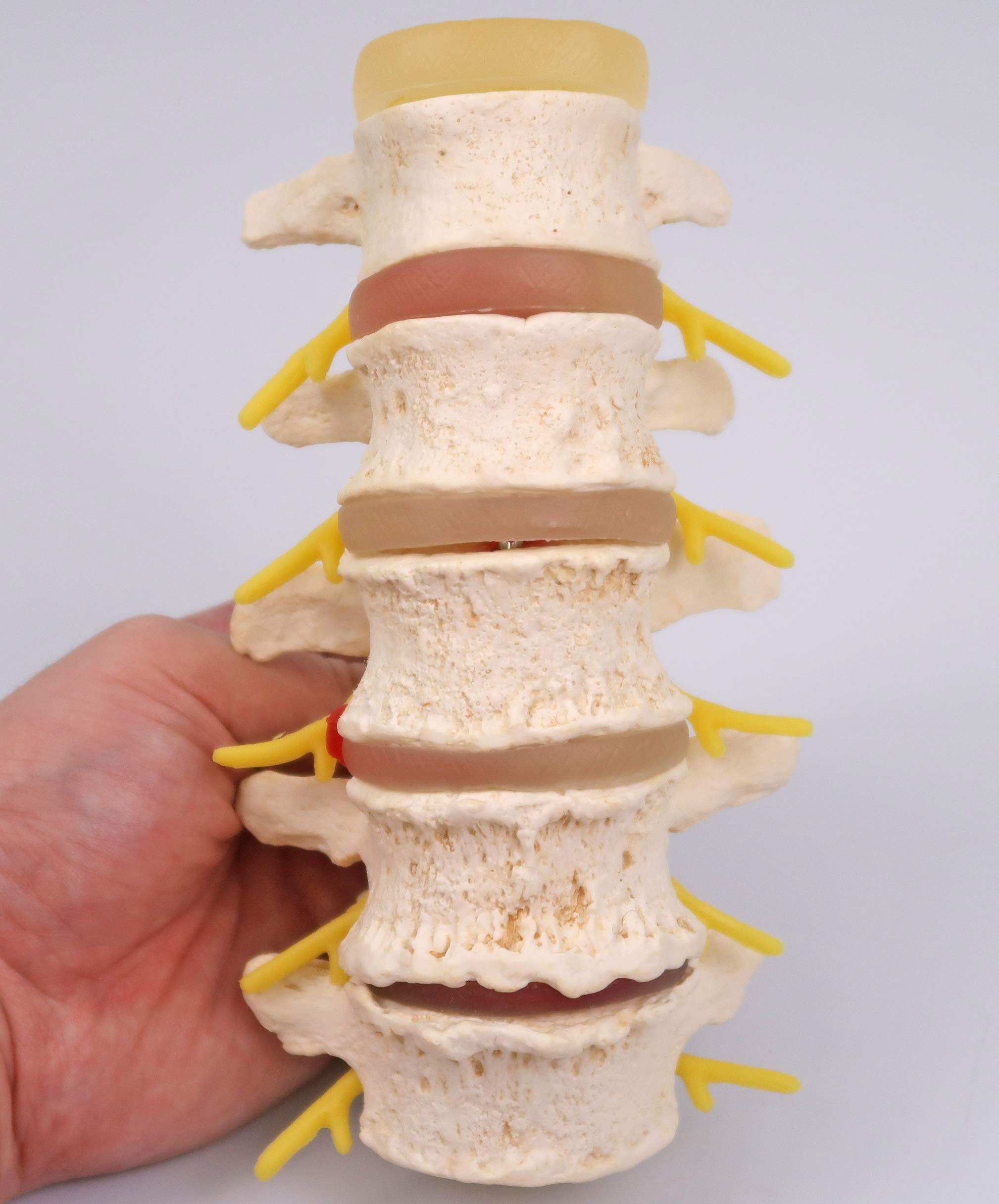 3B Scientific A795 Stadi dell'Ernia del Disco Intervertebrale e Degenerazione della Vertebra + software gratuito di anatomia - 3B Smart Anatomy