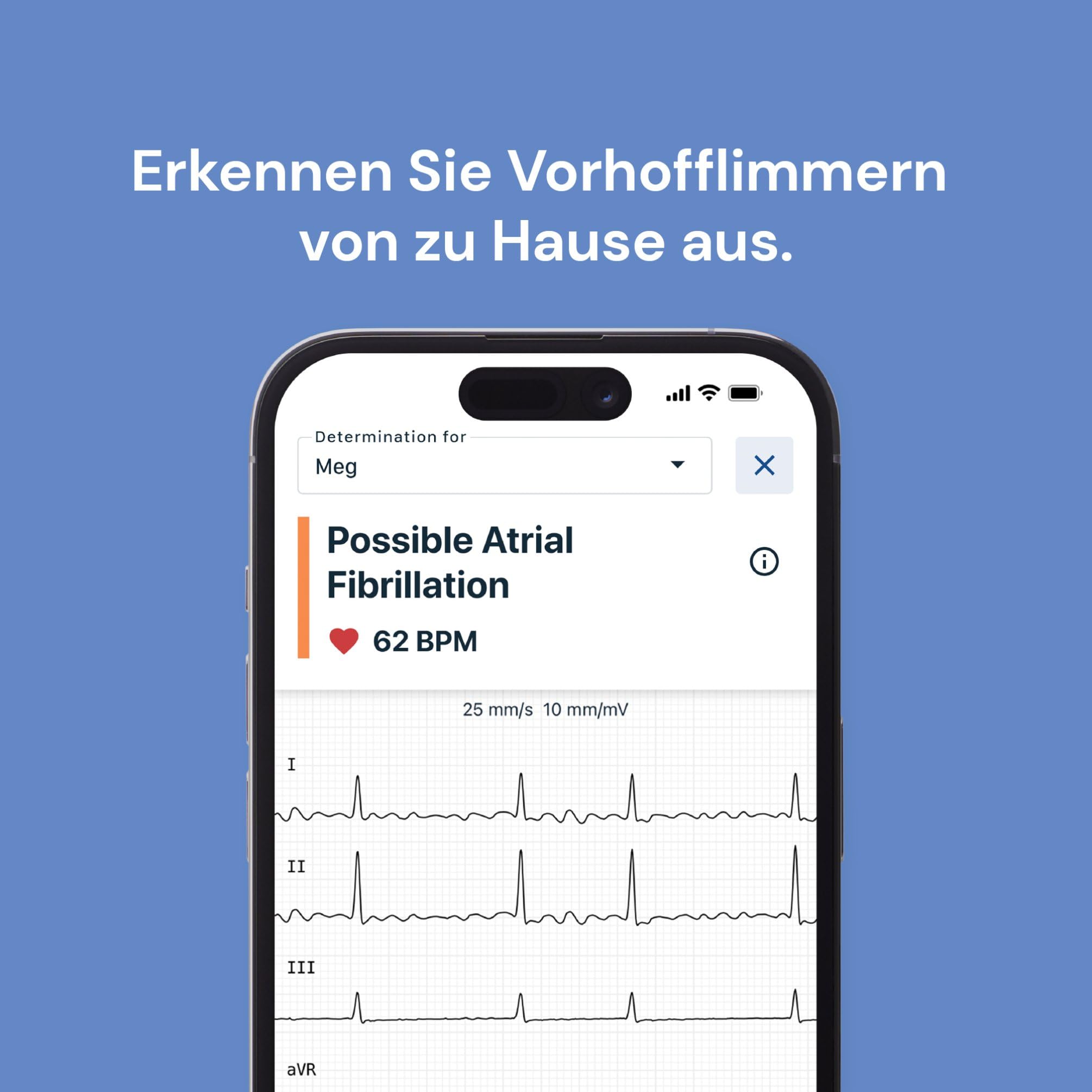 KardiaMobile 6-Kanal Personal-EKG Herzfrequenz-Monitor – Sechs Ansichten des Herzens, erkennt Vorhofflimmern, schnelle Ergebnisse