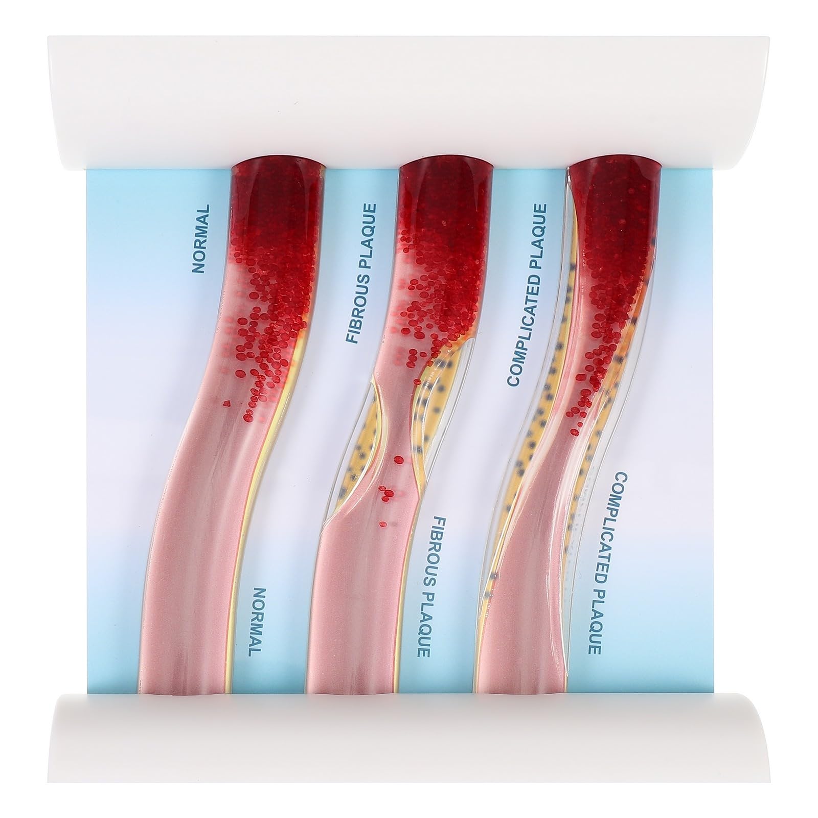 MAGICLULU Modelo de Vaso Sanguíneo Didáctico Simulación de Daño por Lipoproteínas de Baja Densidad, Material Duradero para Enseñanza y Prácticas Médicas