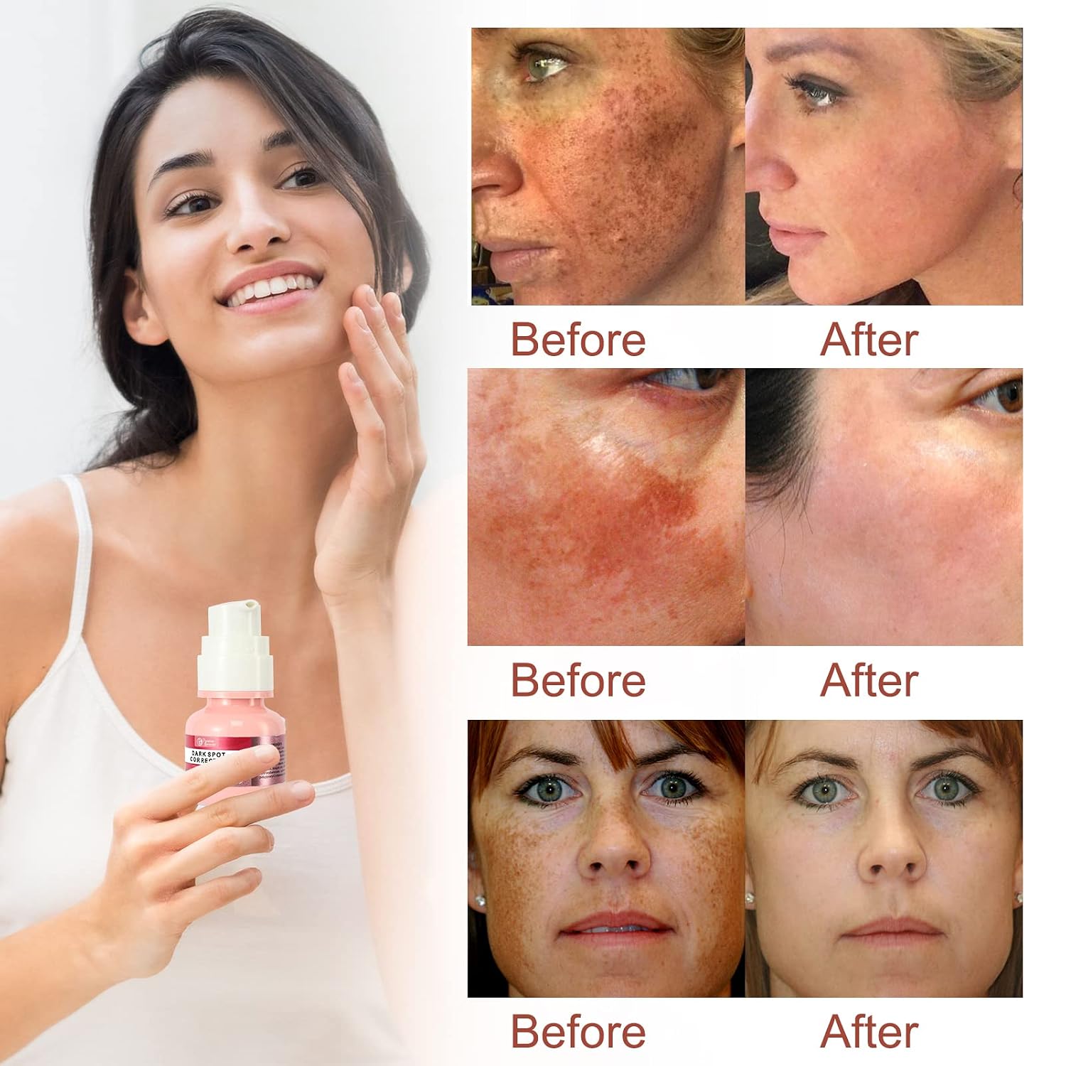 Dark Spot Remover for Face and Body, Dark Spot Corrector, Melasma, Sun Spots, Freckle Remover, Hyperpigmentation Treatment, Formulated for Better Absorption, Discoloration Correcting Serum and Cream Pack, Natural Ingredients-Set of 2