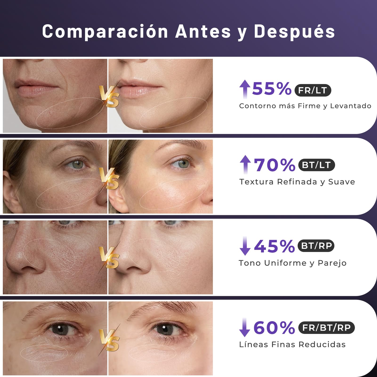 Aparato Radiofrecuencia Facial, 5 en 1 Masajeador Facial de Microcorriente, Dispositivo Eléctrico de Belleza Antiarrugas, Antiacné, Reafirmante y Lifting para Rostro y Cuello (Púrpura)
