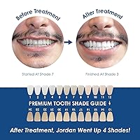 Vista 7 de Recambio de jeringa blanqueadora de dientes de lujo para eliminar la decoloración de los dientes mientras combate las bacterias de la placa, juego