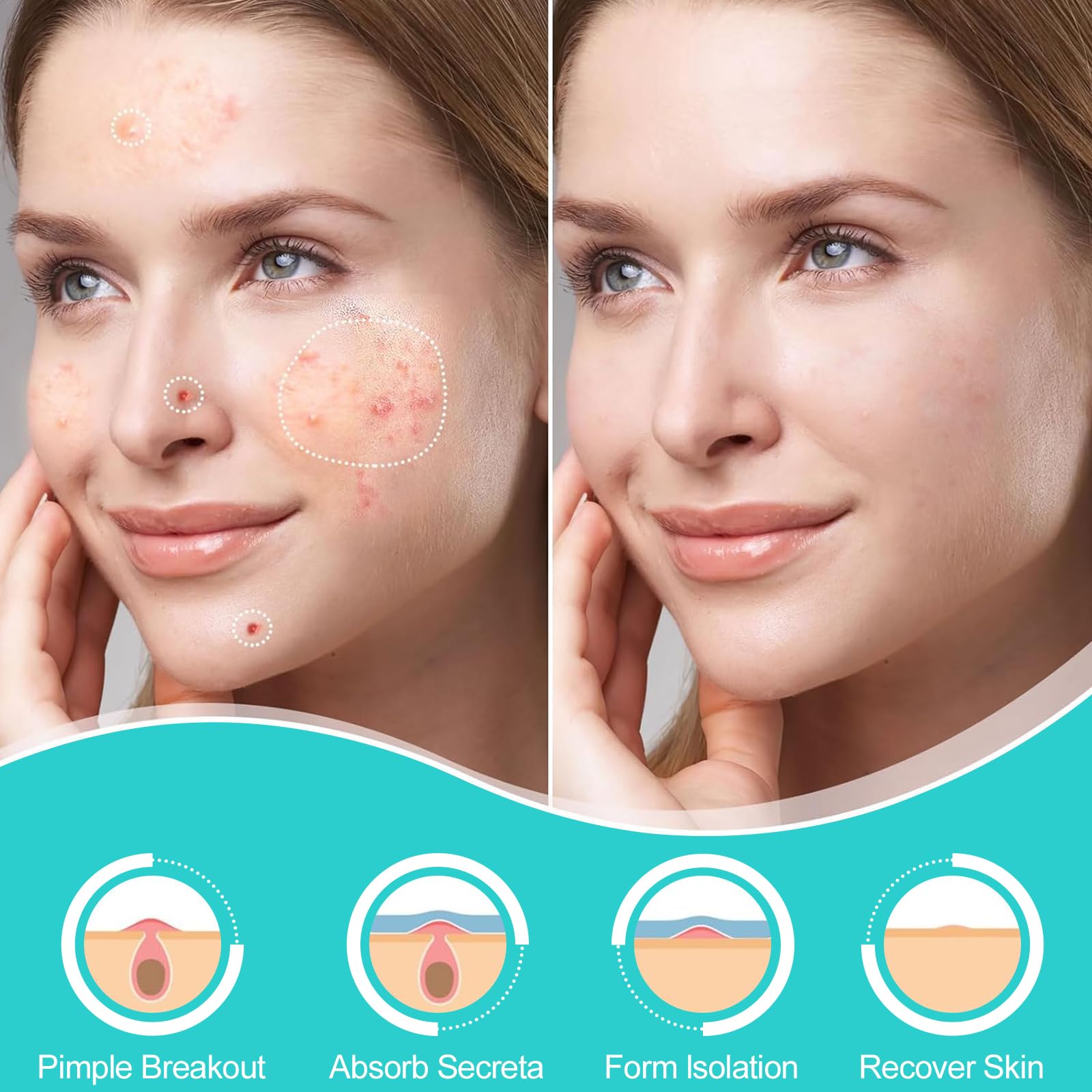 Cerotti per Brufoli 306 Pezzi con Olio dell'Albero del Tè e Acido Salicilico - Patch Brufoli Acne Invisibili, Impermeabili e Traspiranti per Giorno e Notte, Rimuovono Velocemente i Brufoli e l'Acne