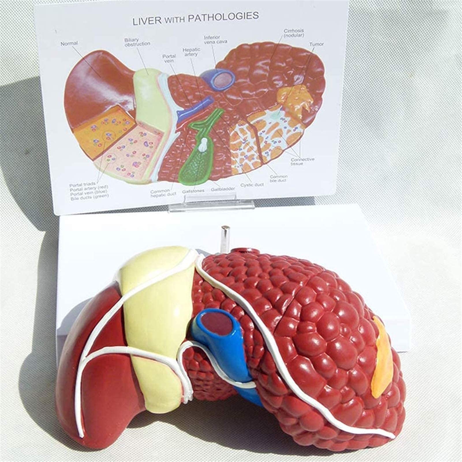 Buy Anatomy Model, Liver Model - Anatomical Human Liver Pathological ...