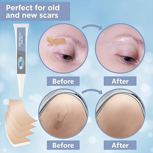 Miniatura 6 de Hojas de gel de silicona para cicatrices - Crema de cicatrices para cicatrices quirúrgicas - Paquete de 5 parches de silicona para cicatrices y gel