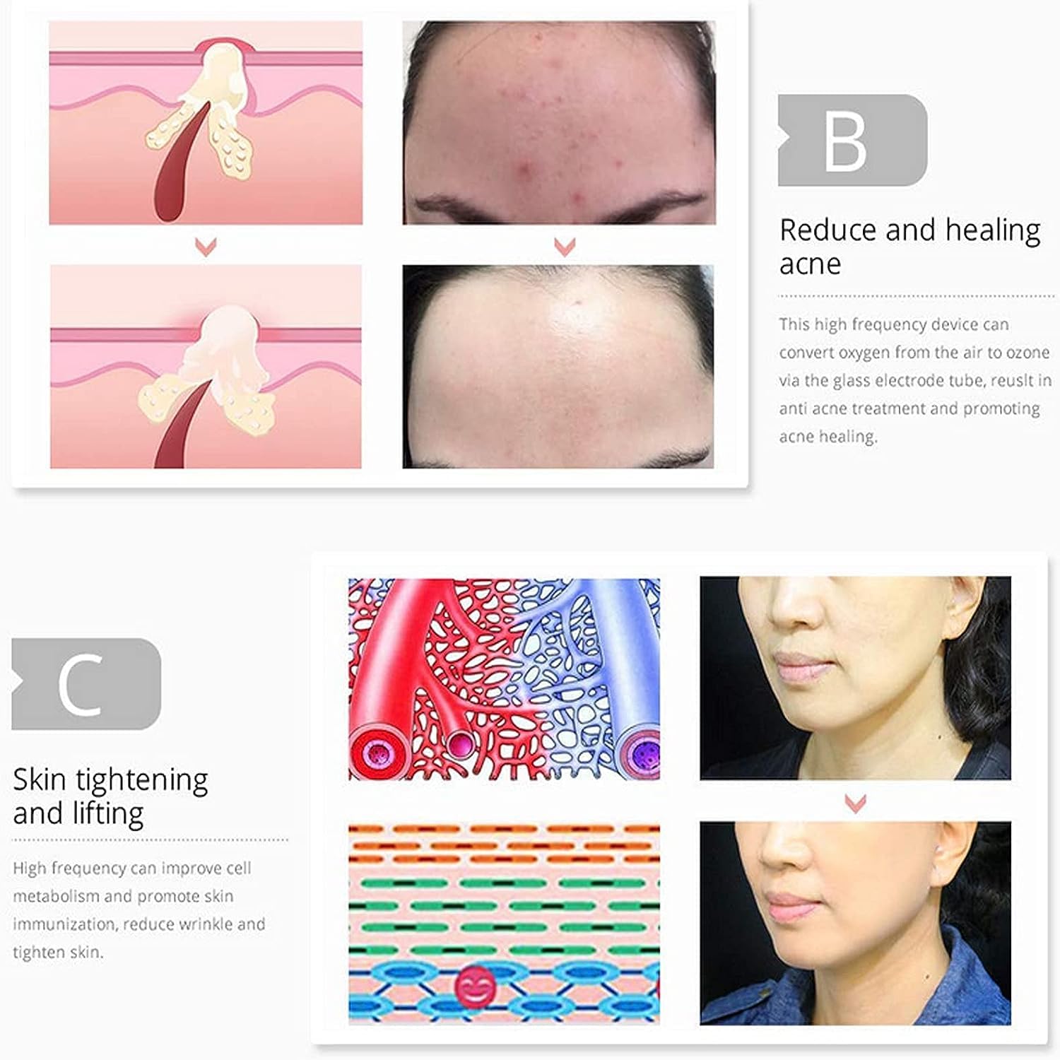 Hi Frequency Facial Care Tool & O Electrode Tubes Bundle