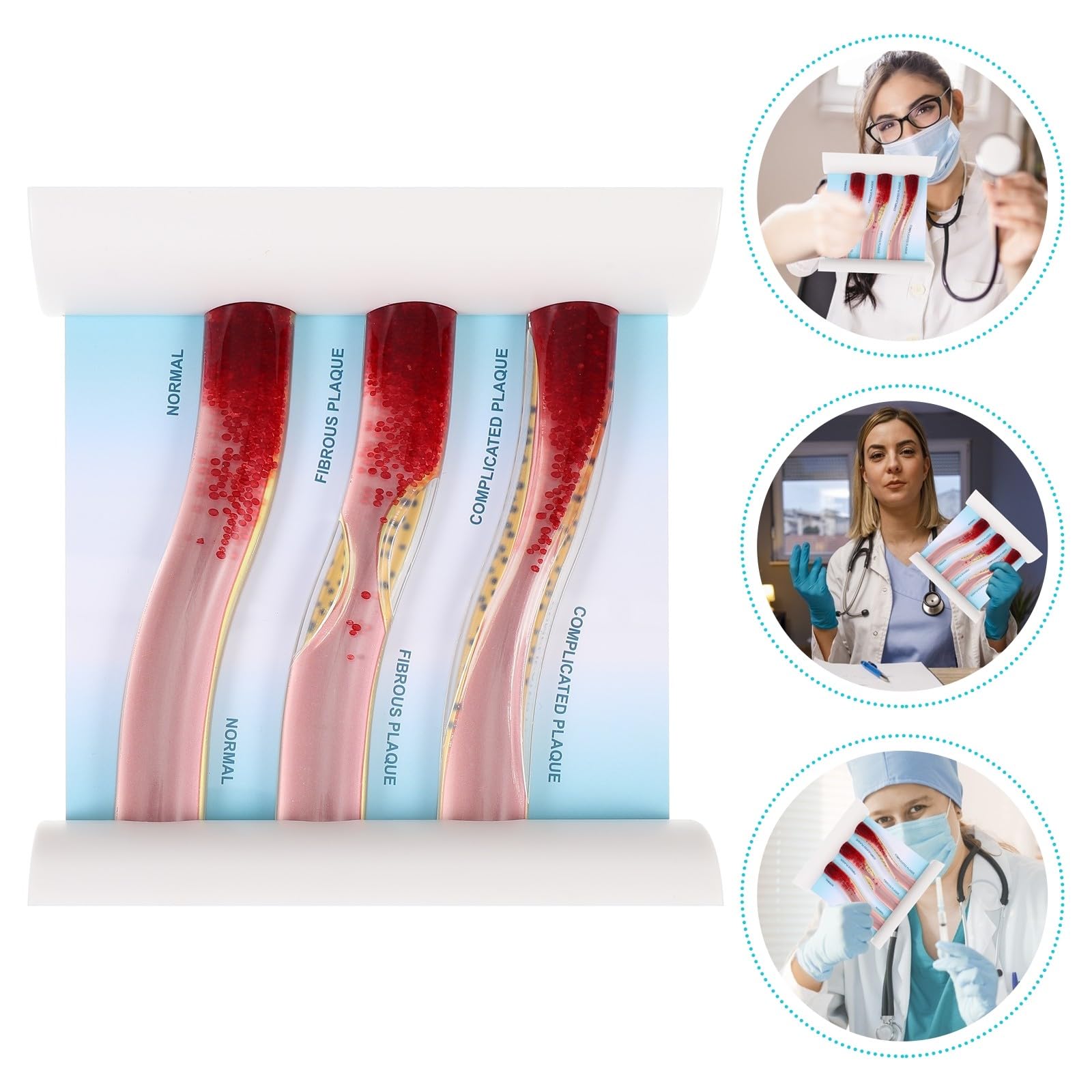 MAGICLULU Modelo de Vaso Sanguíneo Didáctico Simulación de Daño por Lipoproteínas de Baja Densidad, Material Duradero para Enseñanza y Prácticas Médicas