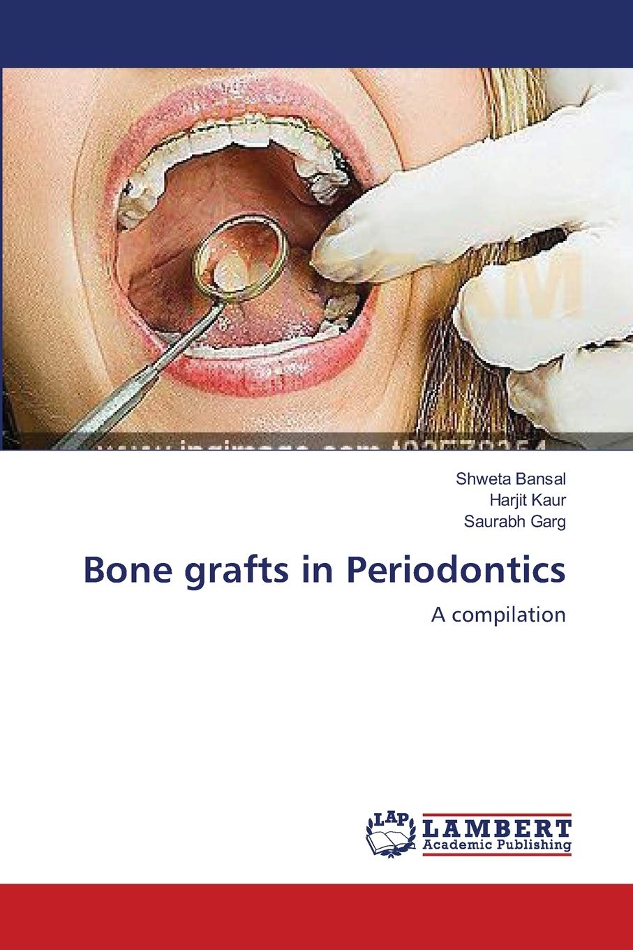 Bone grafts in Periodontics: A compilation