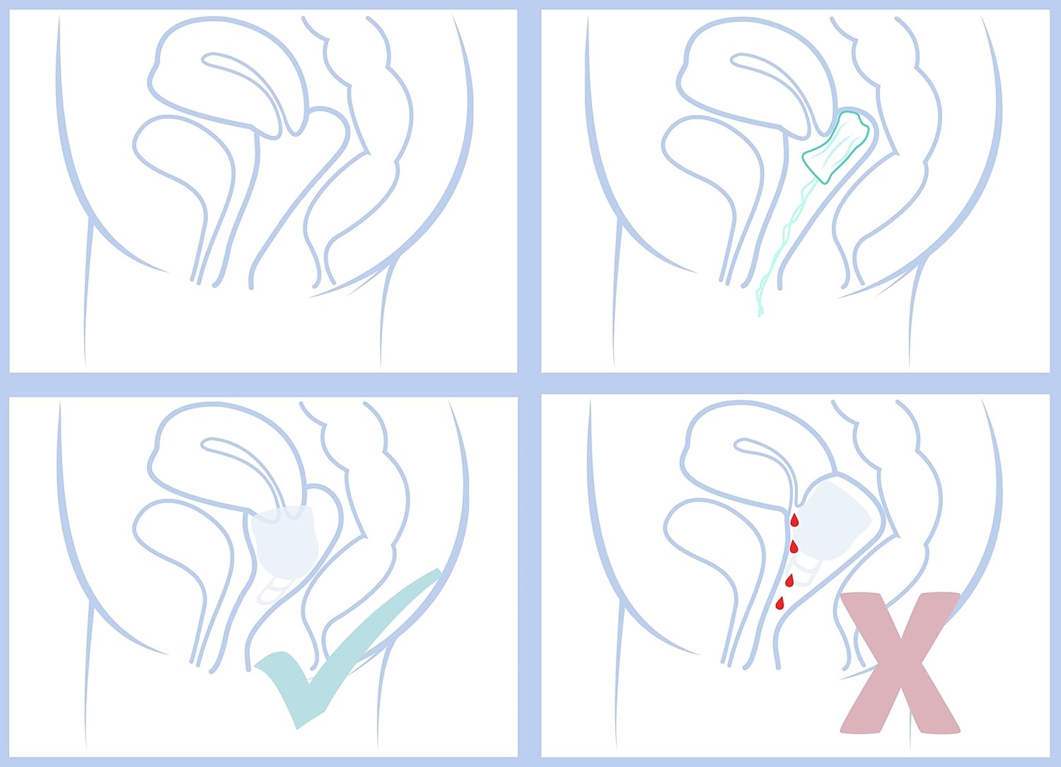 Merula Cup XL ice - The Menstrual Cup for Very Heavy Flow Days