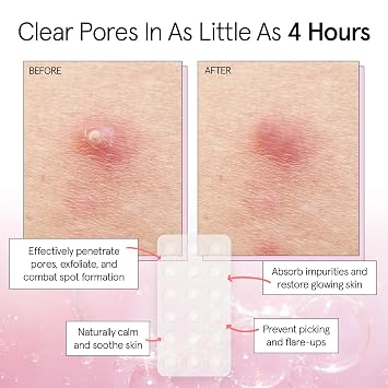 grace & stella Award Winning Multi-Size Pimple Patches for Face - Dermatologist Tested Acne Patches for Face - Hydrocolloid Patch for Breakouts, Whiteheads - Vegan Pimple Patch (Clear, 36 Pack)