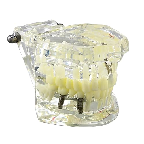Miniatura 3 de Multifarious Tipos Modelo Dental Dientes Removibles Implante Ortodoncia Enseñanza Estudiar Modelos de demostración para Dentista Estudiante Escuela