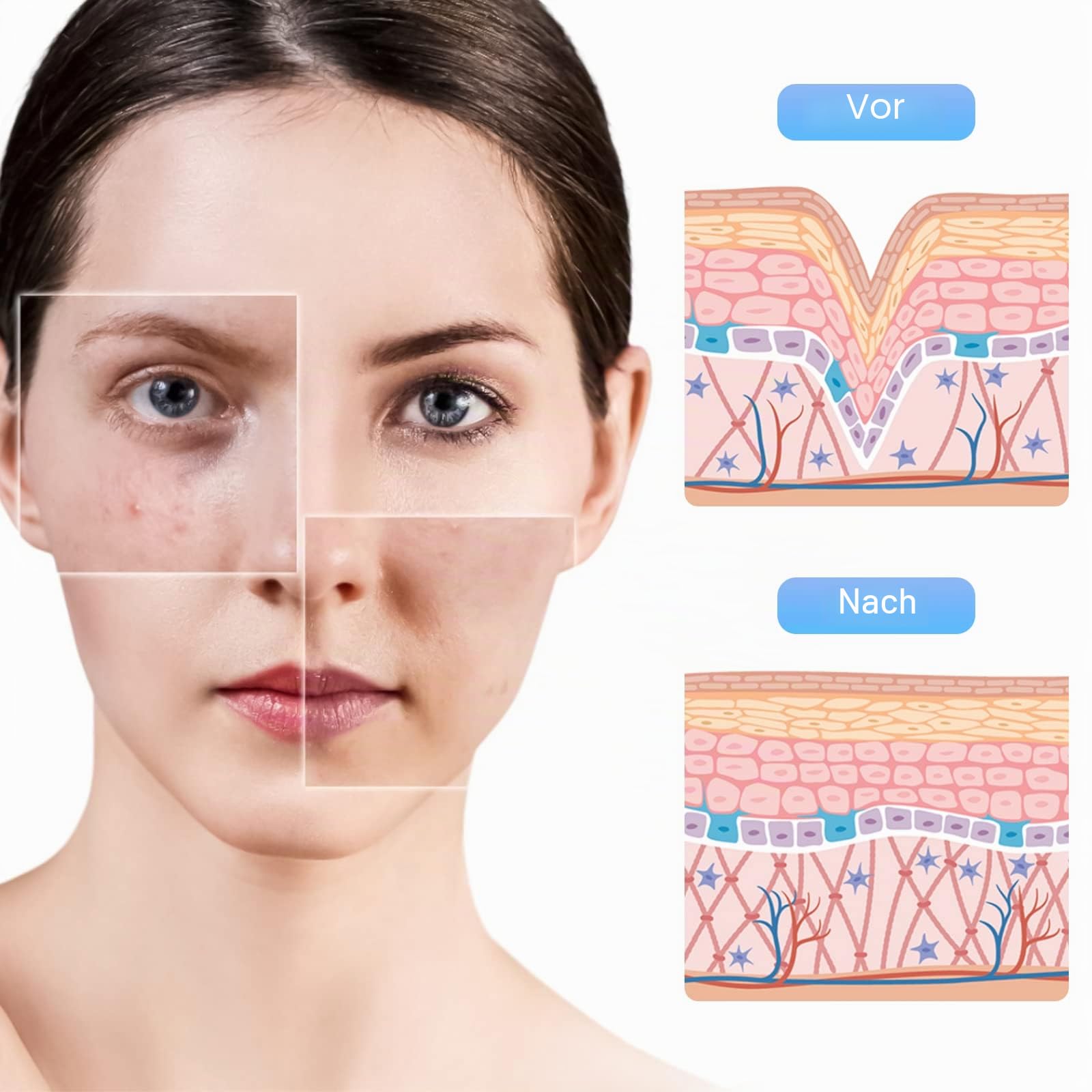 Microneedling Nadeln 10 Stück, 12 Pin-Ersatznadelpatronen für Dermapen M8S/A8S/A9, 10 Stück/Packung, 3 Steckplätze Design