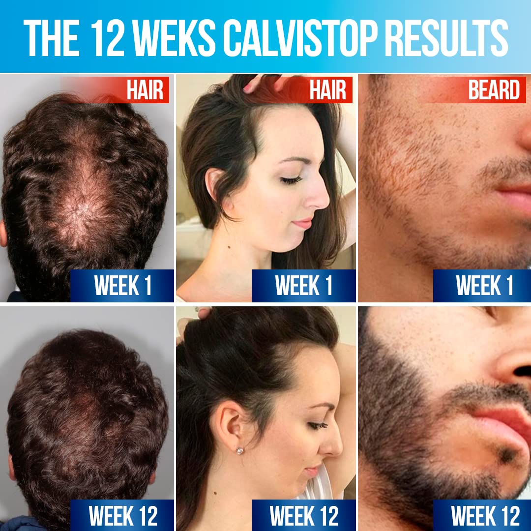 CalviStop Hair Loss Treatment - Stronger, Healthier Ireland | Ubuy CalviStop Hair Loss Treatment - Stronger, Healthier Ireland | Ubuy