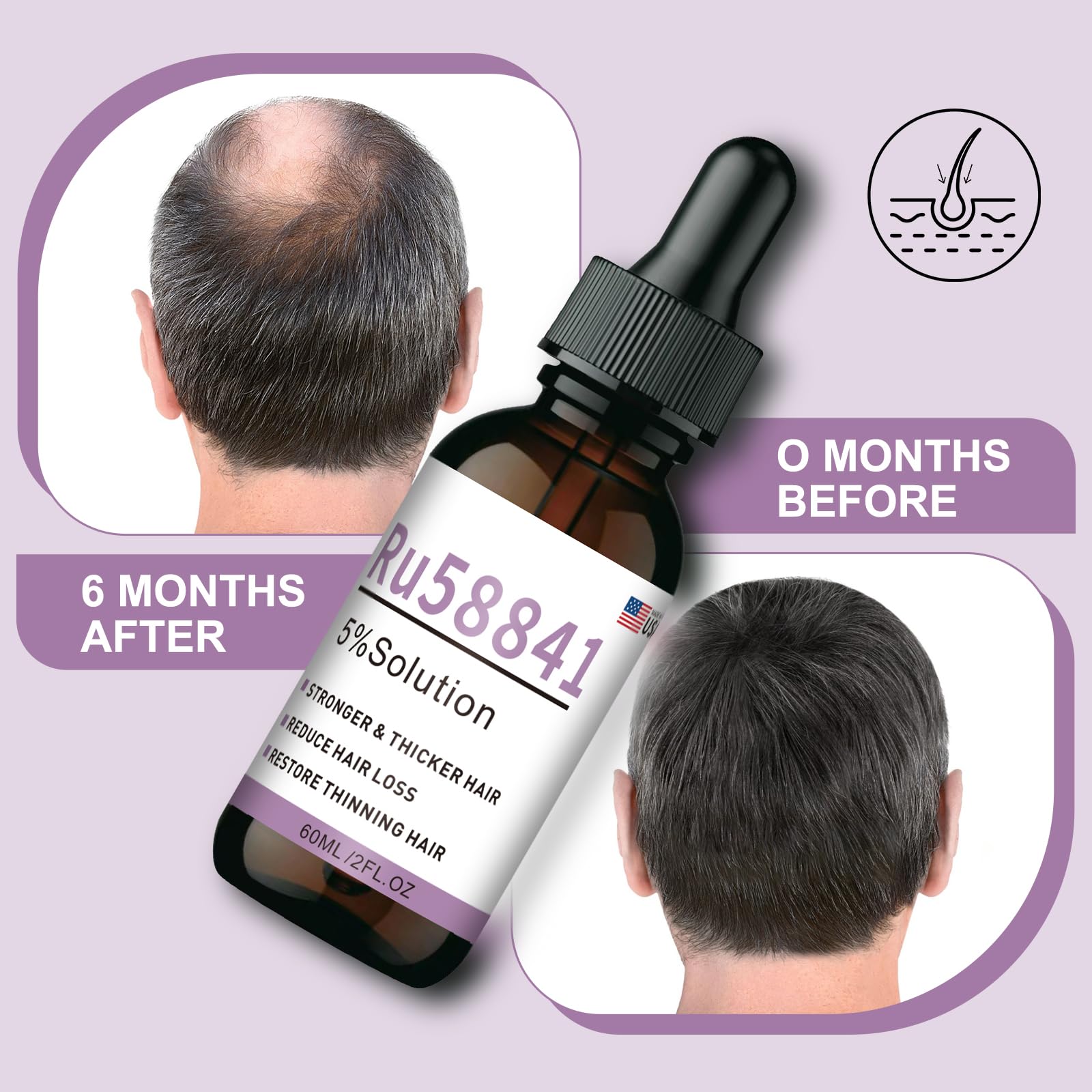 Amazon.com : RU58841 5% Hair Rescue Serum – 50ml DHT Blocker for