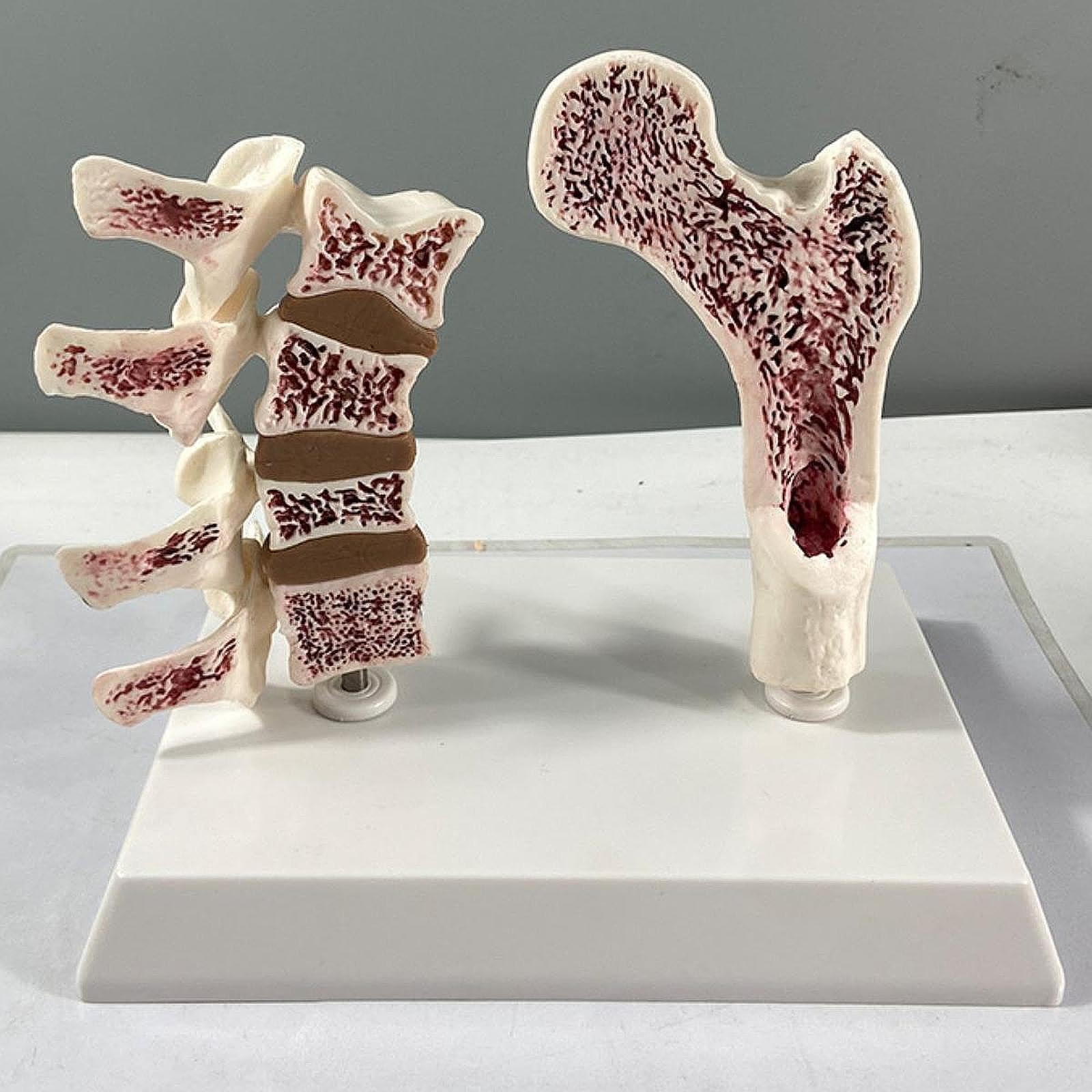 Modelo Portátil de Fémur Humano con Osteoporosis, Esqueleto Educativo con Vértebras, Kit de Aprendizaje de Material de PVC, Adecuado para La