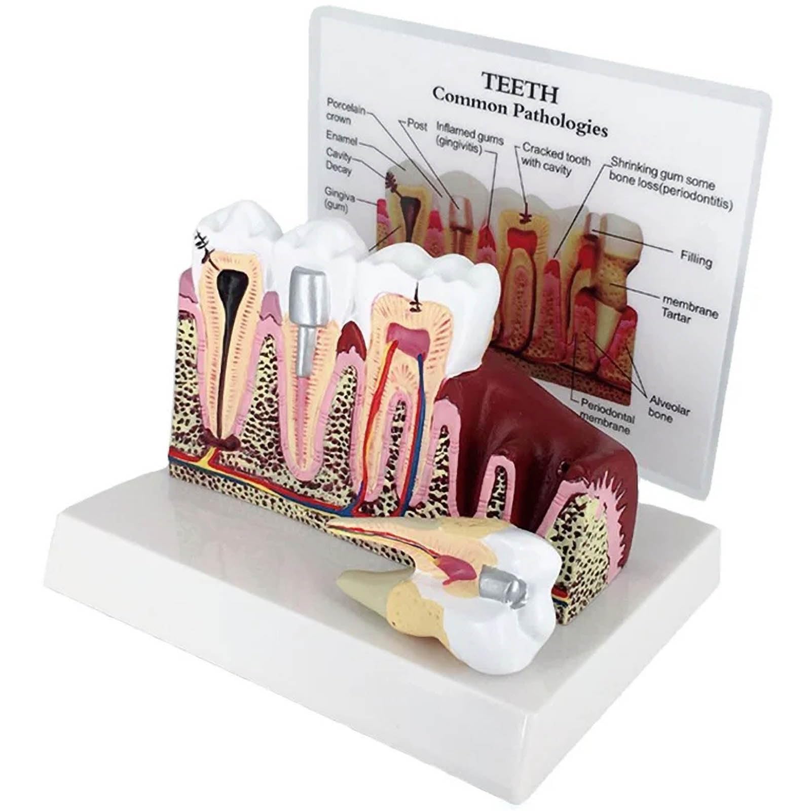 POCDOKYZ Standard Dental Oral Teeth, Anatomical Teaching Model,Human Tooth Disease Tooth Decay + Gum Redness And Swelling Model+English Annotation + Detachable,for Dental Demonstration,Natural
