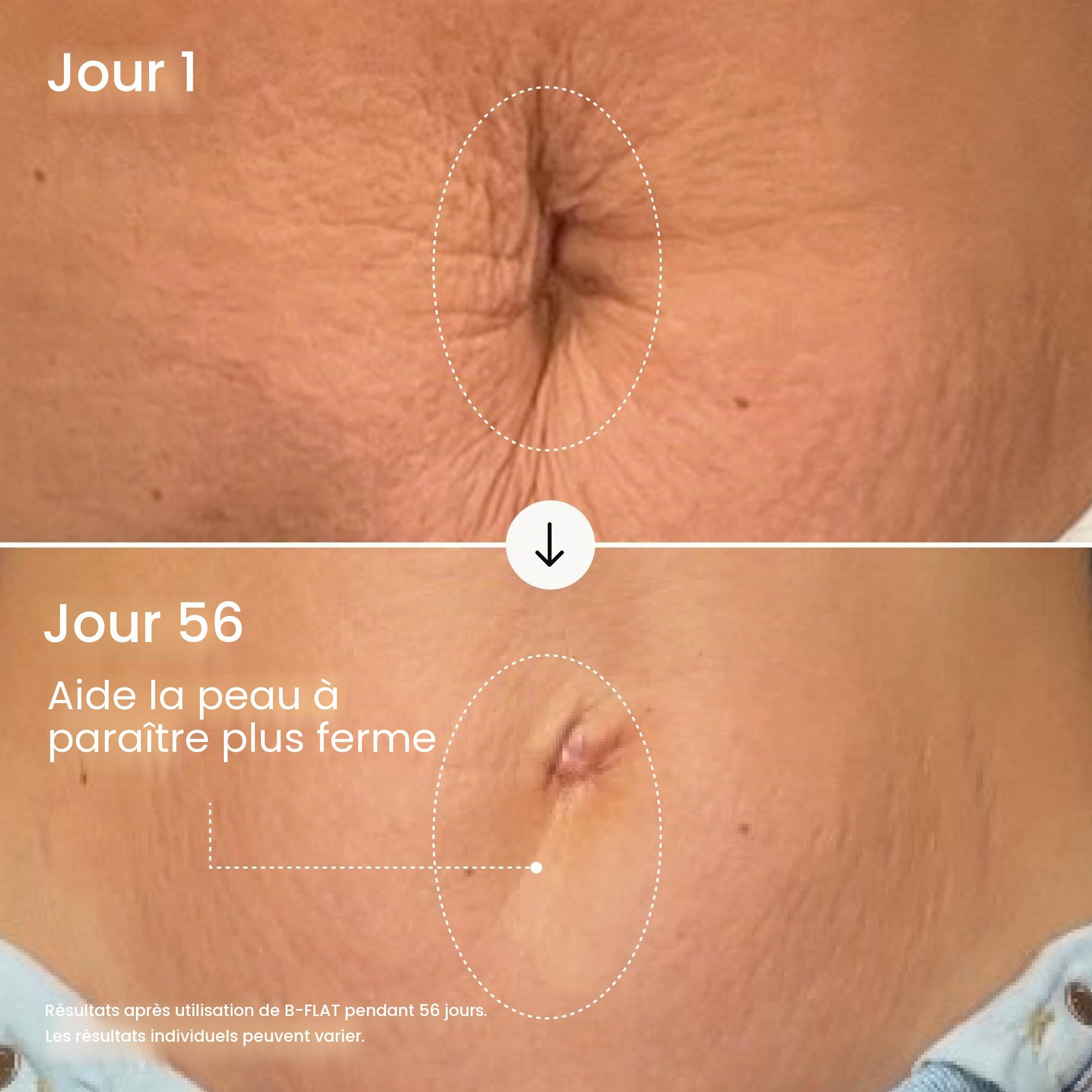 B-Flat Cellulite Stretch Marks Firming Cream | Belly Skin Treatment | Anti-Cellulite Stomach Lotion with Arabica Coffee & Hyaluronic Acid