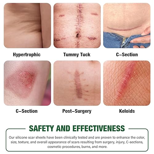 Miniatura 3 de Hojas de silicona para cicatrices, cinta de silicona para cicatrices, láminas de silicona para cicatrices quirúrgicas, eliminación de golpes