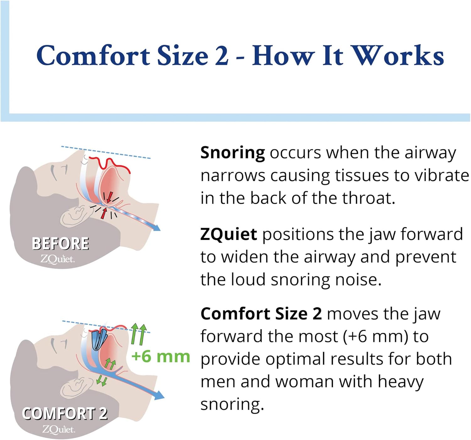 ZQuiet Anti-Snoring Mouthpiece Solution - Comfort Size #2 (Single Device) + Cleaner (1.5oz Bottle) - Made in USA Snoring Solution for a Better Night’s Sleep (Blue) : Health & Household