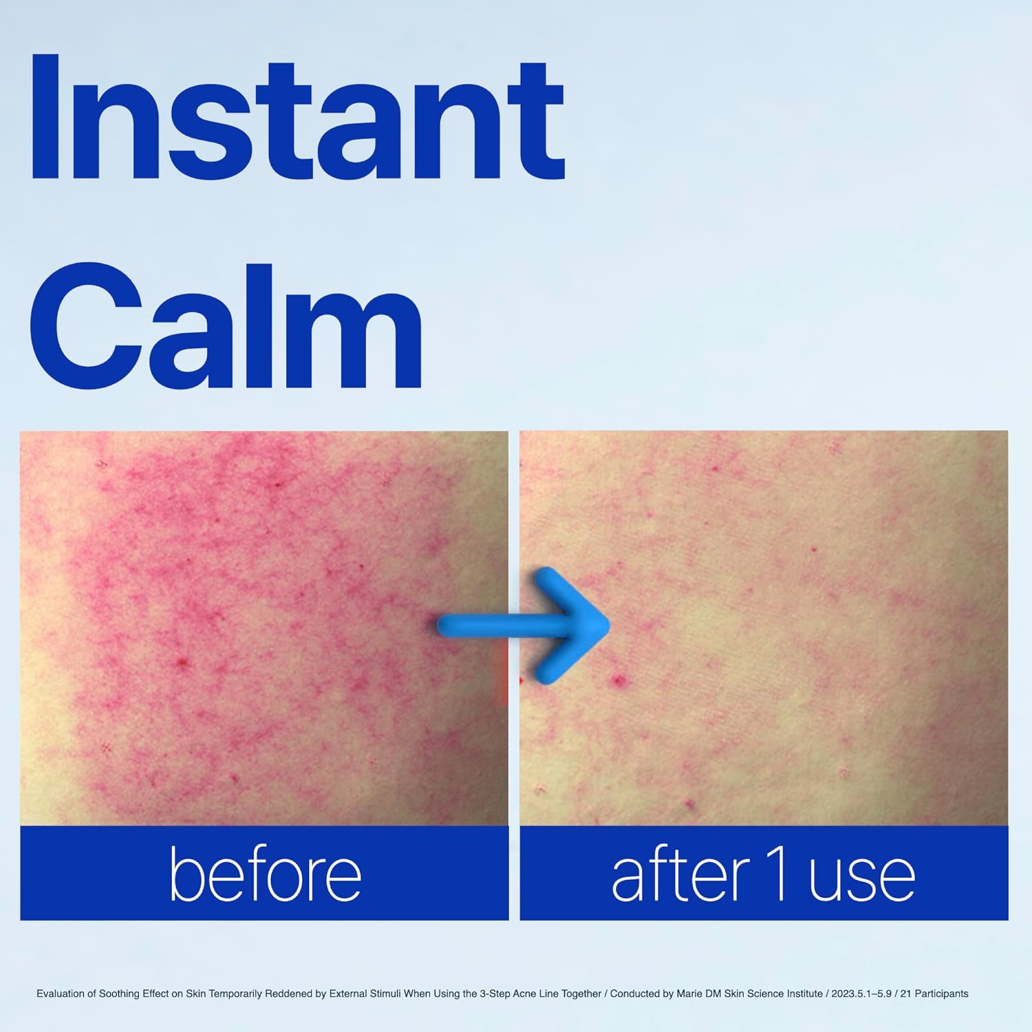 ISOI ACNI Dr. 1st Speedy Gel Cream, Oil-Free Soothing & Hydrating Gel for Oily and Sensitive Skin, Lightweight Cooling Moisturizer for Redness Relief, Korean Skin Care (1.69 fl.oz, 50ml) - Image 2