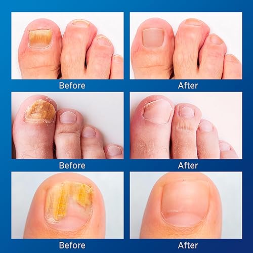 Miniatura 3 de Tratamiento de hongos en las uñas de los pies extra fuerte  Tratamiento de hongos en las uñas para uñas de los pies extra fuerte  Parches nocturnos