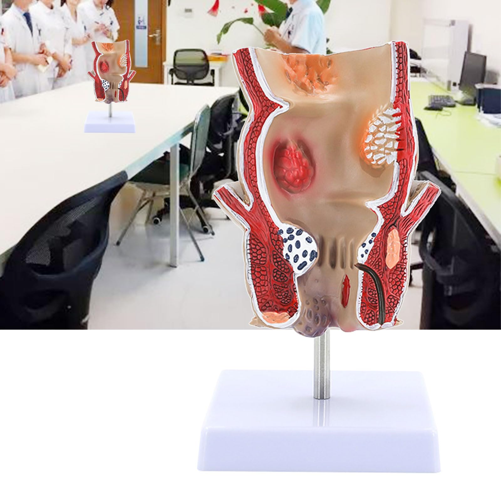 Xiaoxu Modèle de Rectum pour travaux Pratiques en Anatomie Humaine : Pathologies du Rectum, Outil pédagogique en Anatomie.