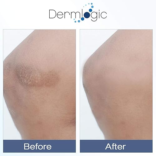 Miniatura 4 de Crema de vitamina K, fórmula hidratante para curación de moretones. Corrector de manchas oscuras para hematomas, arañas vasculares y capilares