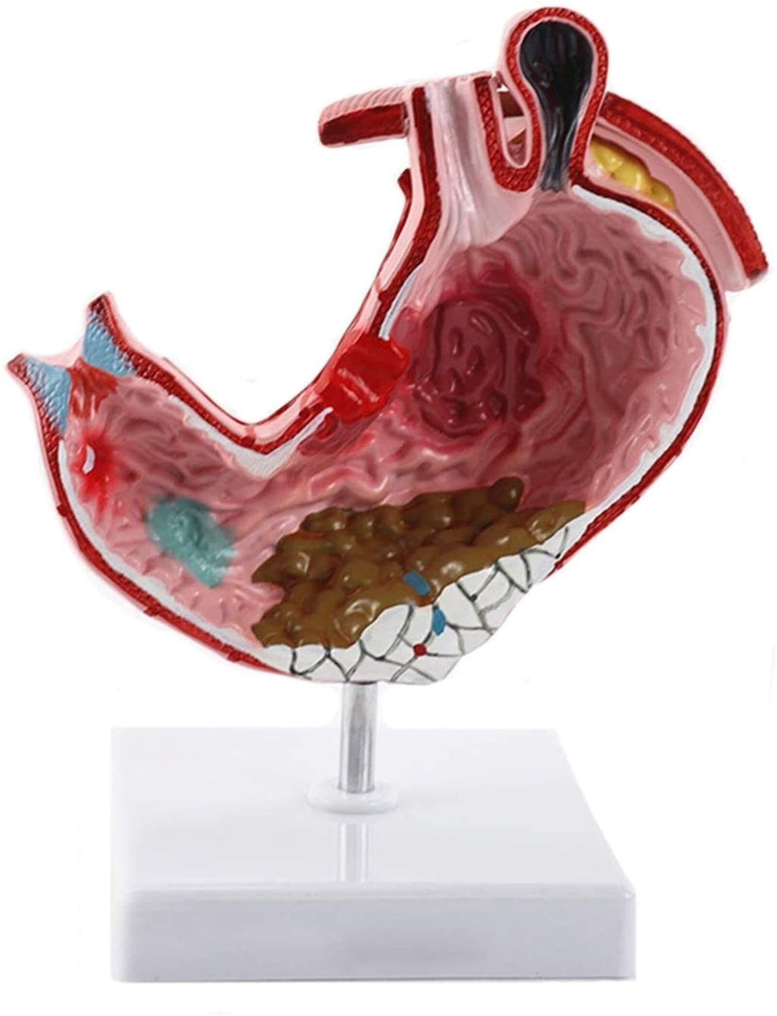 XINGLUOY Gastric pathology medical anatomy model human stomach gastritis ulcer teaching learning tool