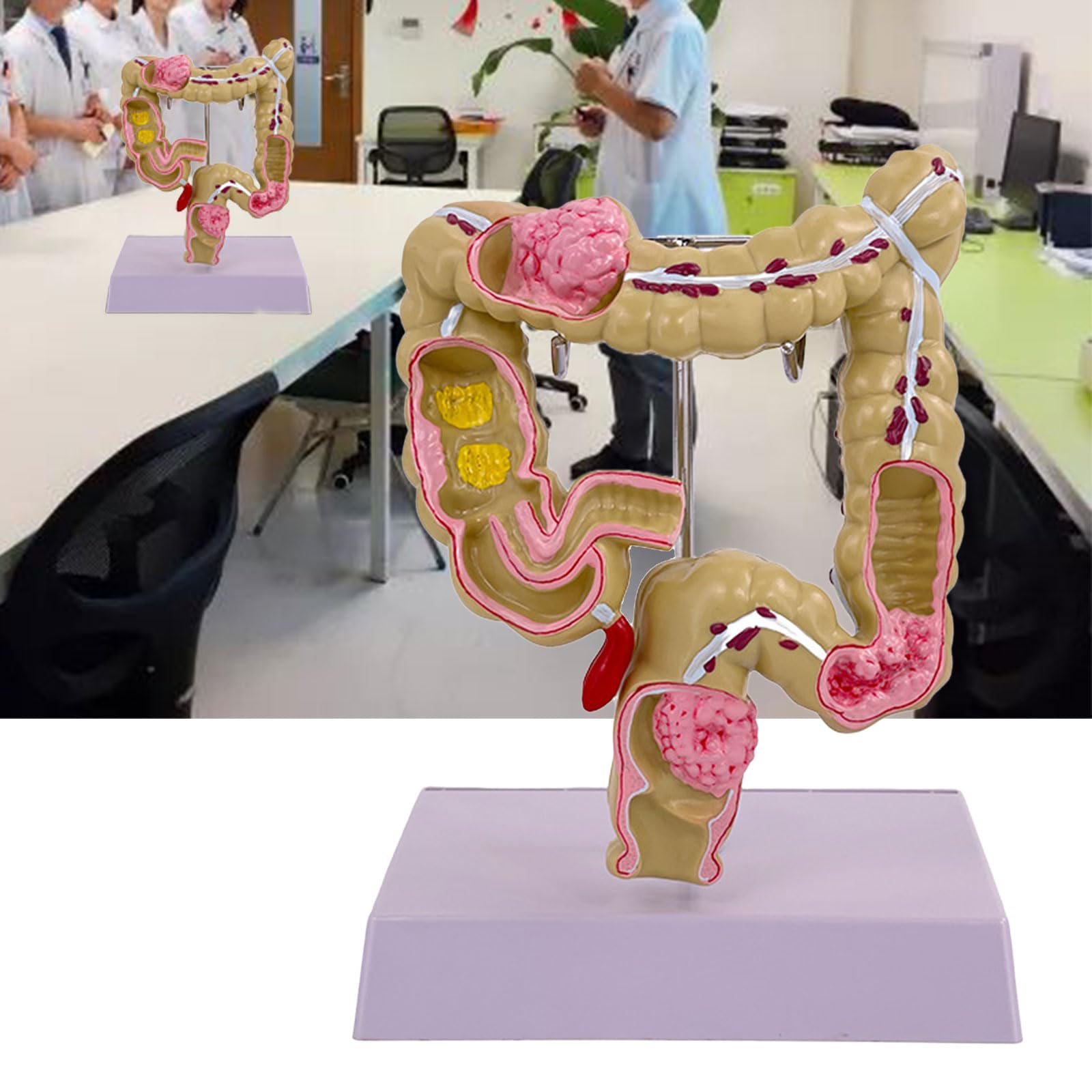 Modello umano dell'intestino crasso Patologie umane del modello dell'intestino crasso Strumento didattico per studi scolastici di laboratorio Patologie del modello dell'intestino crasso Modello di