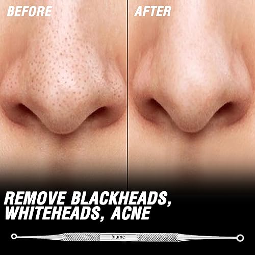 Miniatura 2 de Removedor de espinillas, removedor de espinillas, extractor de comedia, herramienta para el acné, Komedon de doble cara, suave al tacto y