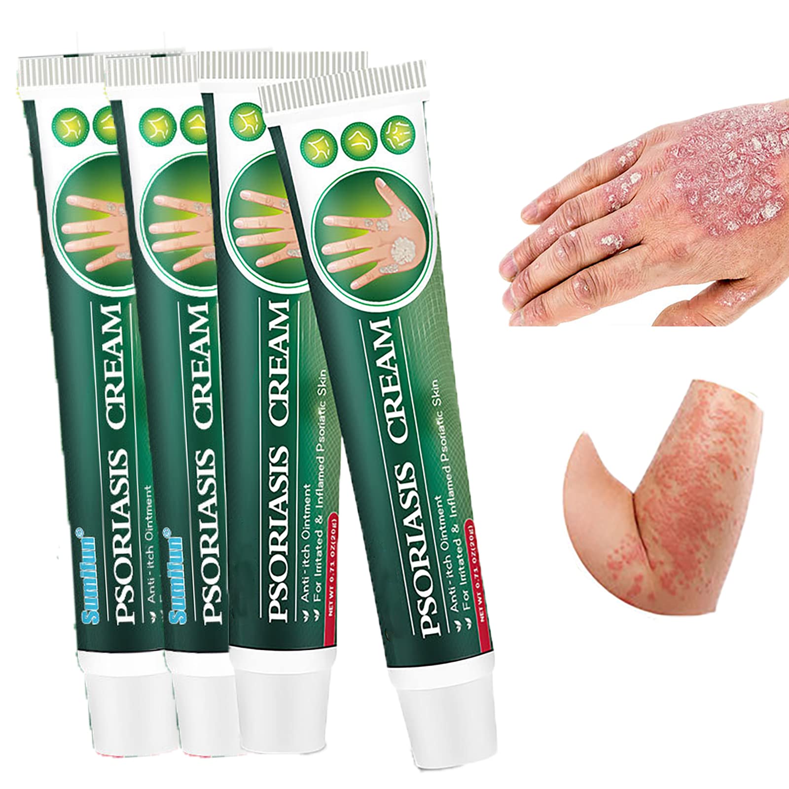 Buy 2/3/4PCS Skinmedix Psoriasis Cream, Zlimplify Psoriasis Cream