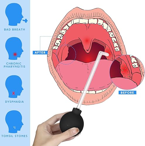 Miniatura 3 de TrelaCo Herramienta de extracción de piedra de amígdala, tubo de vidrio, herramienta de ventosas de piedra de amígdala, removedor de piedra de